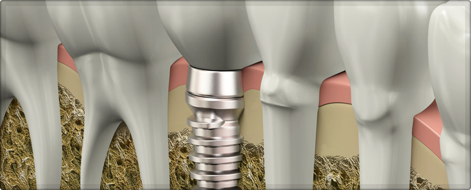 Dental Implant in Ahmedabad