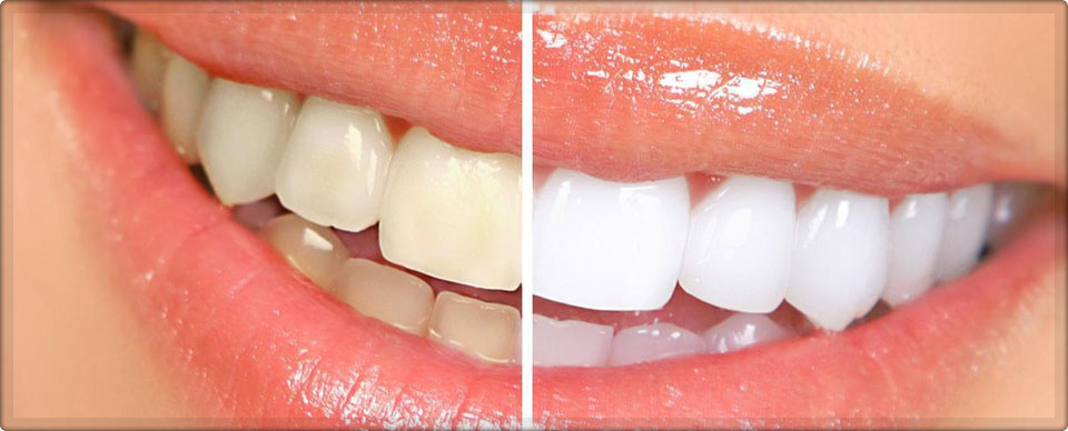 Teeth Whitening in India